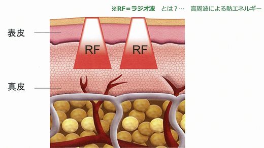 RF=ラジオ波とは