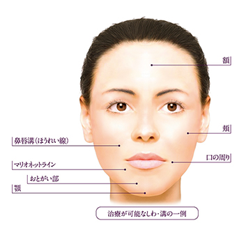 ヒアルロン酸注入